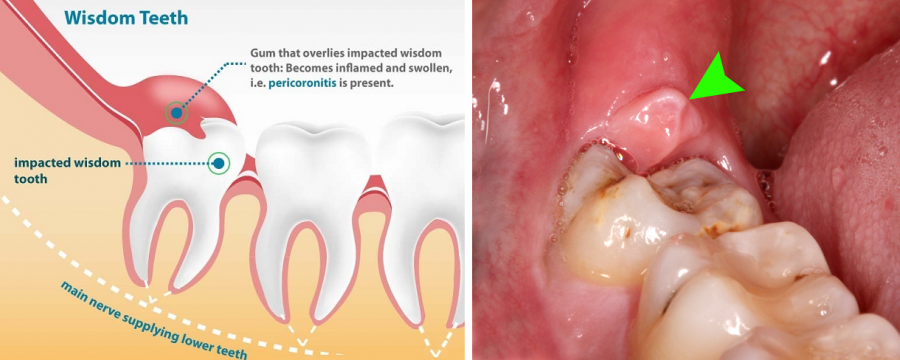 Wisdom-Tooth-Removal-Surgery-Specialist-in-Pune